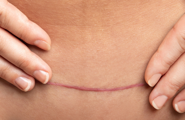 Close-up of a woman's lower abdomen showing a healed c-section scar