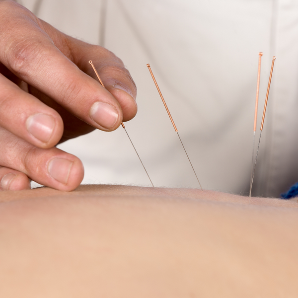 Acupuncture and Optimising Fertility Success with PCOS