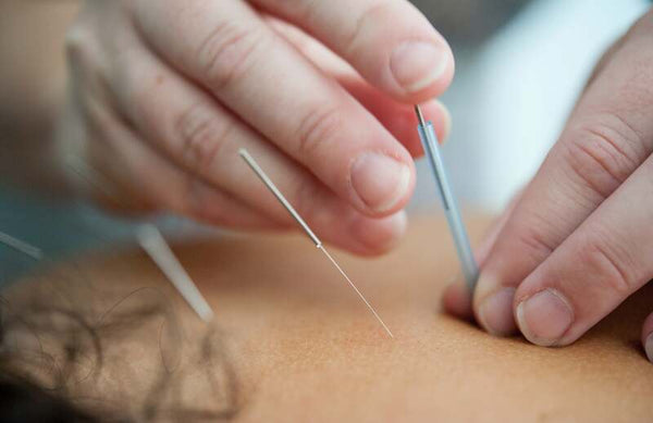 Close-up of hands inserting acupuncture needles into a person's back